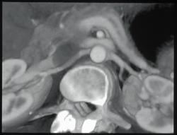 Normal Renal Arteries - CTisus CT Scan