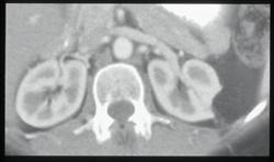 Angiomyolipoma (AML) of Left Kidney - CTisus CT Scan