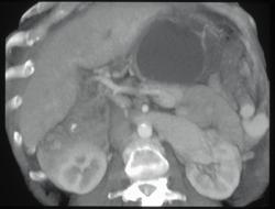 Huge Left Renal Vein Due to Splenorenal Shunting - CTisus CT Scan