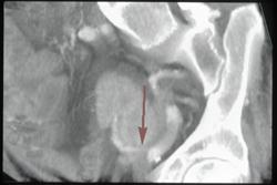 Stenosis of Renal Artery in Transplant Kidney - CTisus CT Scan