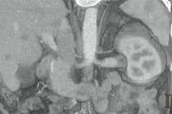 Multiple Renal Arteries - CTisus CT Scan