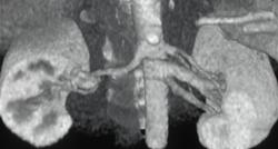 Multiple Left Renal Arteries - CTisus CT Scan