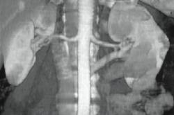 Retroaortic Left Renal Vein - CTisus CT Scan