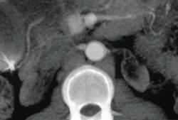 Bilateral Renal Artery Stenosis - CTisus CT Scan