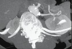 Calcifications at Origin of Renal Artery - CTisus CT Scan