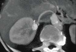 Renal Artery Aneurysm - CTisus CT Scan