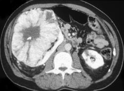 Oncocytoma - CTisus CT Scan