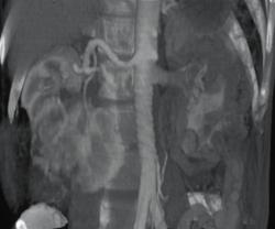 Renal Oncocytoma - CTisus CT Scan