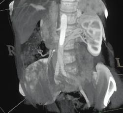 Retroaortic Renal Vein - CTisus CT Scan