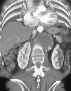 Renal Infarct Due to Aortic Aneurysm - CTisus CT Scan