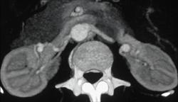 Multiple Renal Artery Aneurysms - CTisus CT Scan