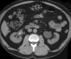 Transitional Cell Carcinoma-right Renal Pelvis - CTisus CT Scan