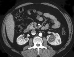 Renal Cyst - CTisus CT Scan