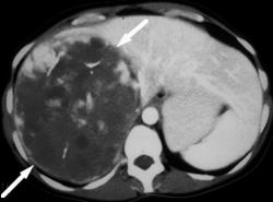 Mesenchymal Tumor - CTisus CT Scan