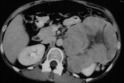 Neuroblastoma - CTisus CT Scan