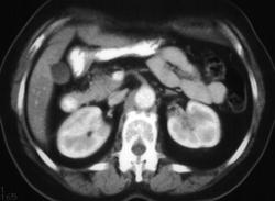 Subtle Early Transitional Cell Cancer (TCC) - left Kidney - CTisus CT Scan