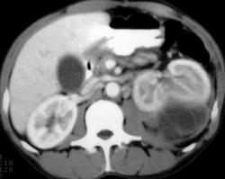 Pancreatic Pseudocyst Pushing Kidney From Behind - CTisus CT Scan