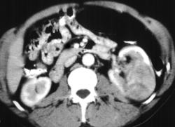 Spiral CT of Renal Cell Carcinoma - CTisus CT Scan