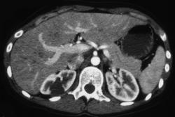 Bosniak I Cyst - CTisus CT Scan