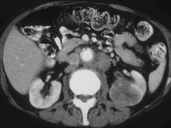 Transitional Cell Carcinoma - CTisus CT Scan