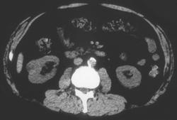 Renal Cell Carcinoma - CTisus CT Scan