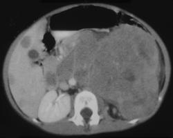 Wilms Tumor - CTisus CT Scan