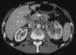 Renal Cell Carcinoma Extends Into the Renal Vein - CTisus CT Scan