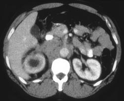 Renal Cell Carcinoma - CTisus CT Scan