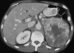 Renal Cell Carcinoma Metastatic to the Mediastinum - CTisus CT Scan