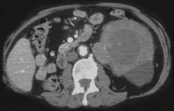 Renal Cell Carcinoma - CTisus CT Scan