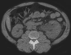 Obstructing Stone in the Distal Left Ureter - CTisus CT Scan