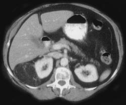 Angiomyolipoma - CTisus CT Scan