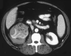 Perirenal Hemorrhage Due to A Renal Cell Carcinoma - CTisus CT Scan