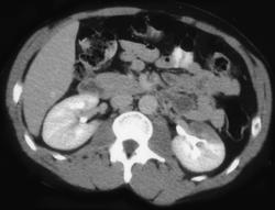 Renal Infarct - CTisus CT Scan