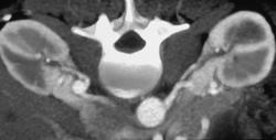 Renal Artery Aneurysms - CTisus CT Scan