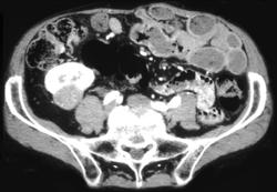 Renal Cell Carcinoma - CTisus CT Scan