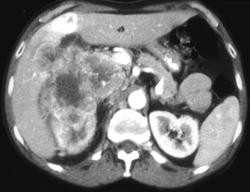 Hypervascular Liver Metastases Due to Renal Cell Carcinoma - CTisus CT Scan