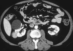 Renal Cell Carcinoma and A Renal Cyst - CTisus CT Scan