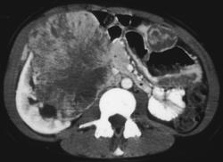 Renal Sarcoma With Lung Metastases - CTisus CT Scan