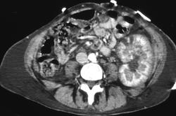 Acute Tubular Necrosis - CTisus CT Scan