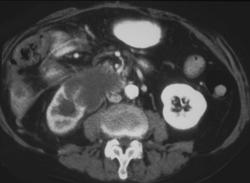 Renal Cell Carcinoma - CTisus CT Scan