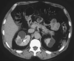 Renal Cell Carcinoma - CTisus CT Scan