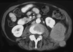 Lymphoma Involves Kidney and Abdominal Wall - CTisus CT Scan