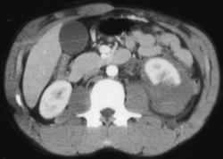 Renal Laceration - CTisus CT Scan