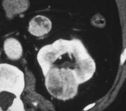 Recurrent Renal Cell Carcinoma - CTisus CT Scan