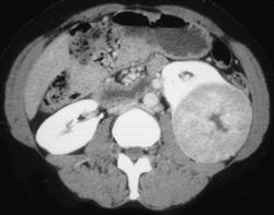 Oncocytoma - CTisus CT Scan