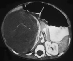 Wilms Tumor - CTisus CT Scan