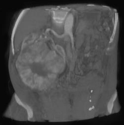 Oncocytoma - CTisus CT Scan