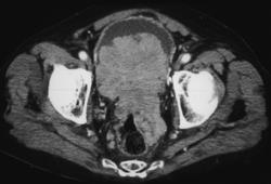 Transitional Cell Carcinoma of the Bladder - CTisus CT Scan