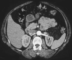 Renal Angiomyolipoma - CTisus CT Scan